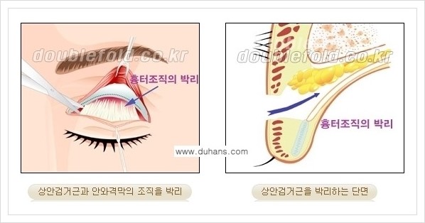 [두한성형외과 경쟁력 쌍꺼풀 재수술(극한 재수술)] - [안검하수(졸리운 눈매) 교정 안내 2.] 관련 이미지 4