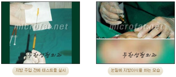 [두한성형외과 지방이식] - [다크써클, 눈​밑주름] 관련 이미지 8