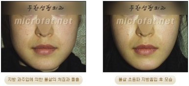 Facial Fat Liposuction at Duhan Plastic Surgery - Cheek Fat Liposuction, Jawline Liposuction, Under-Eye Fat Liposuction image 17