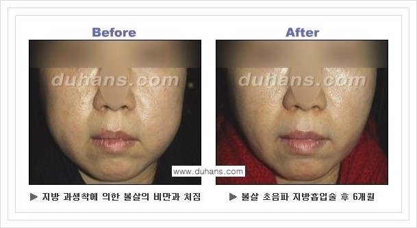 ​​[두한성형외과 경쟁력 지방흡입] - [아름다운 얼굴 윤곽선을 위한  볼살지방흡입, 턱선지방흡입 안내] 관련 이미지 19
