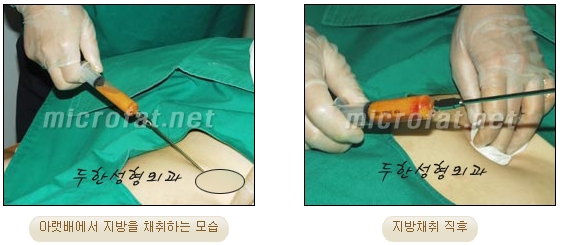 Duhan Plastic Surgery Wrinkle Improvement - Glabellar Horizontal Wrinkles, Glabellar Straight Wrinkles, Glabellar Wrinkle Surgery image 3