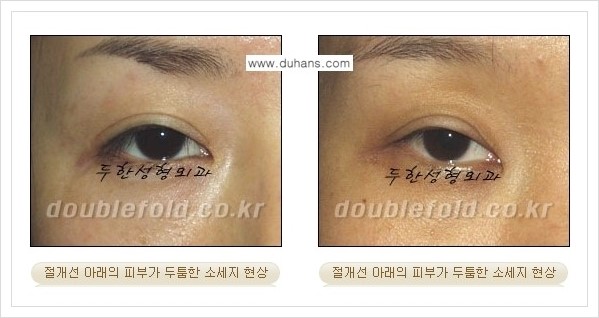[두한성형외과 경쟁력 쌍꺼풀 재수술, 극한 재수술] - [절개선 아래가 두툼한 소세지 쌍꺼풀의 교정 안내] 관련 이미지 1
