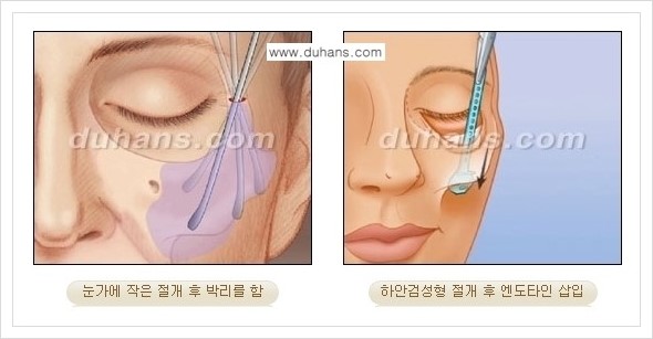 [두한성형외과 경쟁력 주름교정술] - [엔도타인 리프팅 안내 ③] 관련 이미지 8