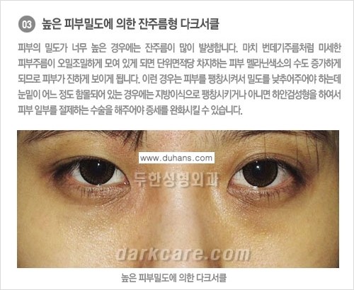 [두한성형외과 NO.1 경쟁력] - [원인과 색에 따른 다크써클의 종류] 관련 이미지 4