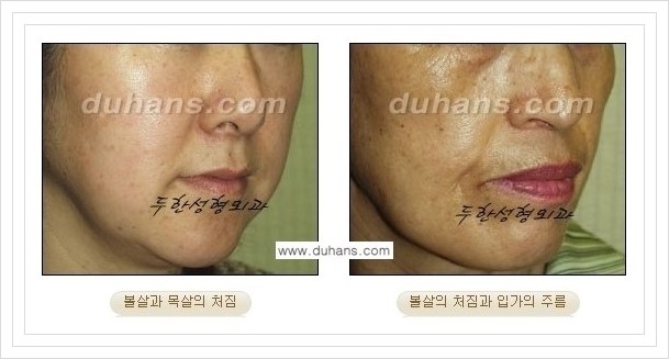 [두한성형외과 경쟁력 주름성형] - [볼처짐 개선, 이마주름 개선을 위한 엔도타인 리프팅 안내] 관련 이미지 2