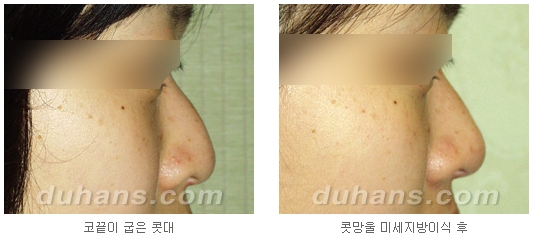 [두한성형외과 얼굴자가지방이식] - [코지방이식] 관련 이미지 13