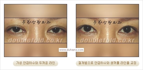 [두한성형외과 경쟁력 쌍꺼풀 재수술, 극한 눈재수술] - [안검하수 검사 및 수술방법 안내] 관련 이미지 17