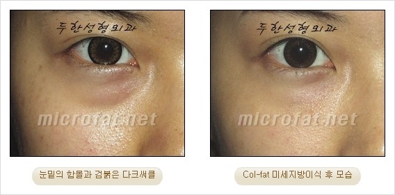 ​[두한성형외과 경쟁력 눈밑성형 리더] - [눈밑 다크써클의 증상, 원인, 종류, 치료방법 안내] 관련 이미지 27