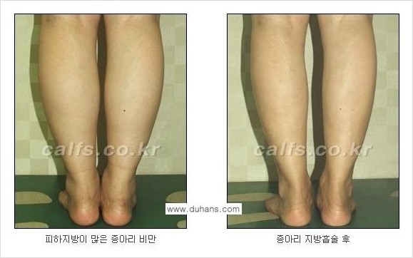 [두한성형외과 경쟁력 멀티종아리성형] - [종아리(다리) 비만 해결 방법 안내] 관련 이미지 5