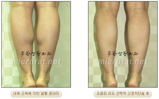 [Duhan Plastic Surgery Clinic Calf Contouring] - [Calf Reduction] image 17