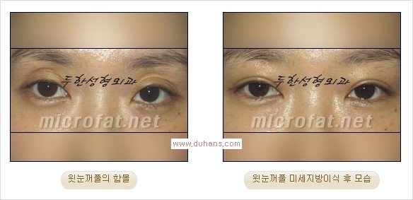 [두한성형외과 경쟁력 쌍꺼풀 재수술, 극한 눈재수술] - [어색한 쌍꺼풀 라인을 교정하는 윗눈꺼풀 미세지방이식] 관련 이미지 14