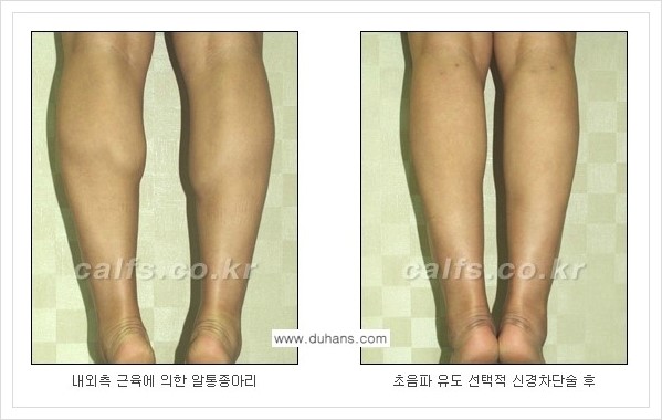 [두한성형외과 경쟁력 멀티종아리성형] - [종아리성형 방법 - 초음파 유도 선택적 신경차단술 안내] 관련 이미지 10