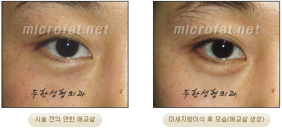 Duhan Plastic Surgery Under-Eye Surgery - Correction with Fat Grafting After Aegyo-Sal Filler image 16