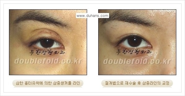 [두한성형외과 경쟁력 쌍꺼풀 재수술] - [삼중 쌍꺼풀 라인의 교정 안내] 관련 이미지 4