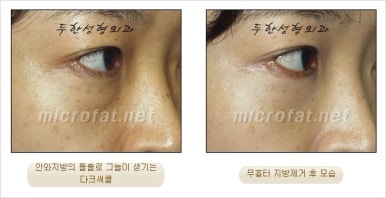 두한성형외과 눈밑수술 - 다크서클 수술 전후 관리 안내 관련 이미지 52