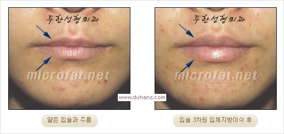 [두한성형외과 경쟁력 미세지방이식] - [입술 3차원 입체지방이식 안내 1.] 관련 이미지 10