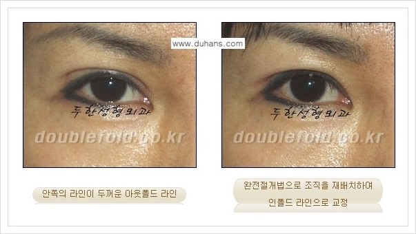 [두한성형외과 경쟁력 쌍꺼풀(눈) 재수술] - [심한 아웃폴드 라인을 인폴드 라인으로의 교정 안내] 관련 이미지 8
