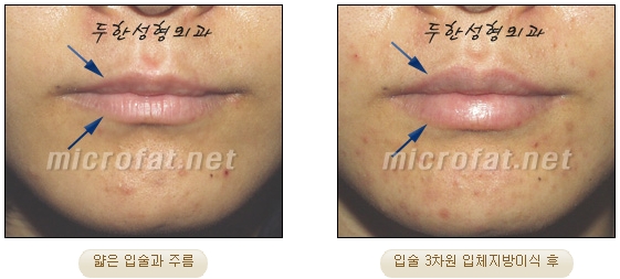 [Duhan Plastic Surgery Lip Surgery] - [Lip Correction Fat Grafting] image 10