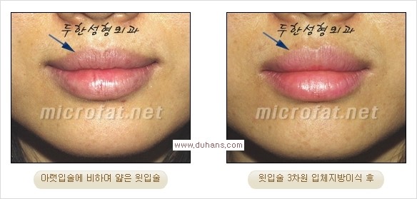 [두한성형외과 경쟁력 미세지방이식] - [입술 3차원 입체지방이식 안내 1.] 관련 이미지 11