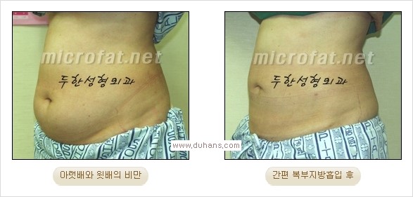 [두한성형외과 경쟁력 지방흡입] - [초음파 지방흡입과 미세흡입관을 이용한 간편지방흡입] 관련 이미지 14