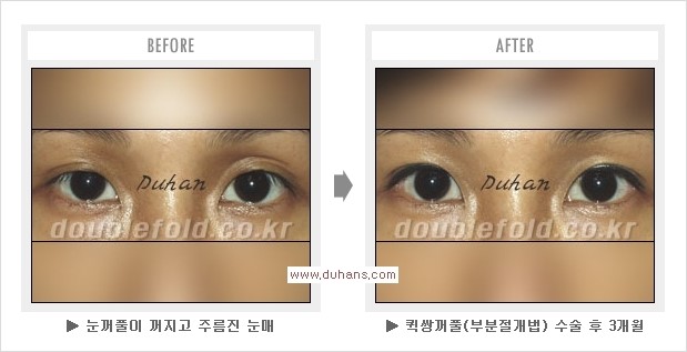 ​[두한성형외과 경쟁력 눈성형] - [퀵쌍꺼풀(부분절개법) 수술 관련 자주하는 질문과 답변] 관련 이미지 6