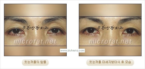 [두한성형외과 경쟁력 미세지방이식] - [꺼진(함몰된) 윗눈꺼풀 미세지방이식] 관련 이미지 13