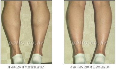 ​[두한성형외과 종아리수술] - [나에게 맞는 종아리성형방법] 관련 이미지 16