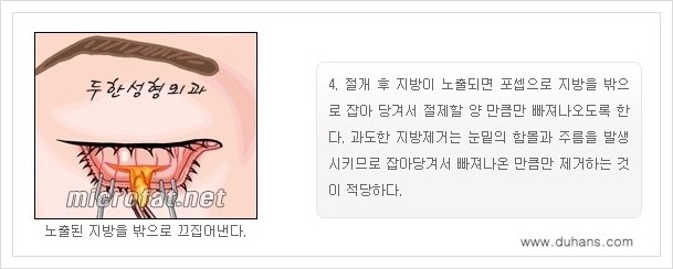 [두한성형외과 경쟁력 지방제거] - [눈밑(눈위)지방제거, 눈꺼풀(윗눈꺼풀)지방제거 안내 ①] 관련 이미지 8