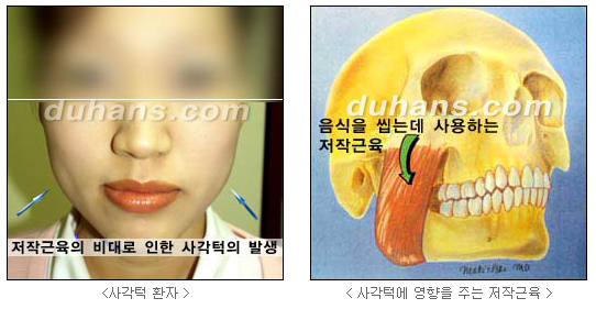[두한성형외과 경쟁력 안면윤곽 성형 리더] - [완변한 V 라인! 턱 미세지방이식, 볼살 미세지방이식, 사각턱 보톡스 안내] 관련 이미지 28