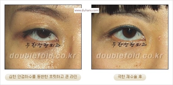 [두한성형외과 경쟁력 쌍꺼풀 재수술 스페셜] - [망가진 라인을 교정하는 극한 재수술] 관련 이미지 21
