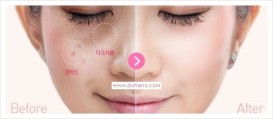 [두한성형외과 경쟁력 눈밑성형] - [다크써클 + 검버섯 레이저 콤비 프로그램 안내] 관련 이미지 1