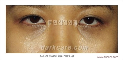 [두한성형외과 경쟁력 눈밑성형] - [다크써클의 원인과 다크써클의 종류] 관련 이미지 11