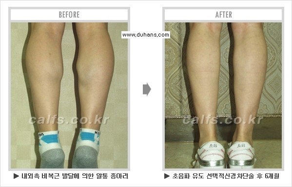[두한성형외과 경쟁력 멀티종아리성형] - [종아리성형 전후 주의해야 할 내용 안내] 관련 이미지 14