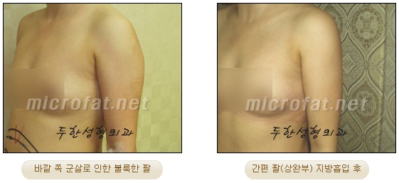 두한성형외과 지방흡입 - 부위별 안전 지방흡입 관련 이미지 23