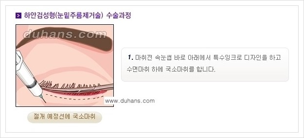 [두한성형외과 경쟁력 안검성형] - [젊은 눈매 하안검 성형술 안내] 관련 이미지 3