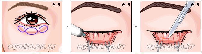 [두한성형외과 지방제거] - [눈두덩이지방제거, 눈밑지방제거] 관련 이미지 12