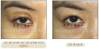 쌍꺼풀수술 두한성형외과 - 쌍커풀재수술의 문제점 관련 이미지 16