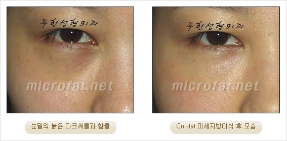 ​[두한성형외과 경쟁력 눈밑성형 리더] - [눈밑 다크써클의 증상, 원인, 종류, 치료방법 안내] 관련 이미지 30