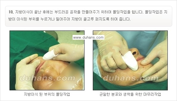 [두한성형외과 경쟁력 미세지방이식] - [부드럽고 아름다운 얼굴선 얼굴 미세지방이식 과정] 관련 이미지 10