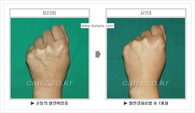 [두한성형외과 정맥류 치료] - [손, 팔 정맥확장증 사진자료 안내 ①] 관련 이미지 3