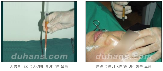 [두한성형외과 주름개선] - [주름교정 방법] 관련 이미지 51