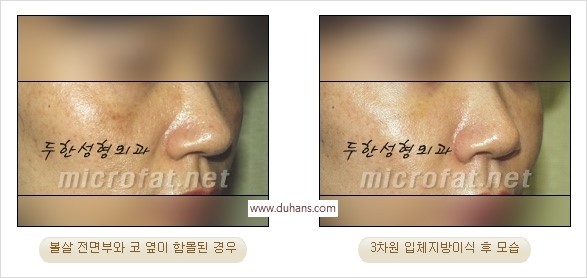 [두한성형외과 경쟁력 미세지방이식] - [귀족수술 입체 미세지방이식] 관련 이미지 10