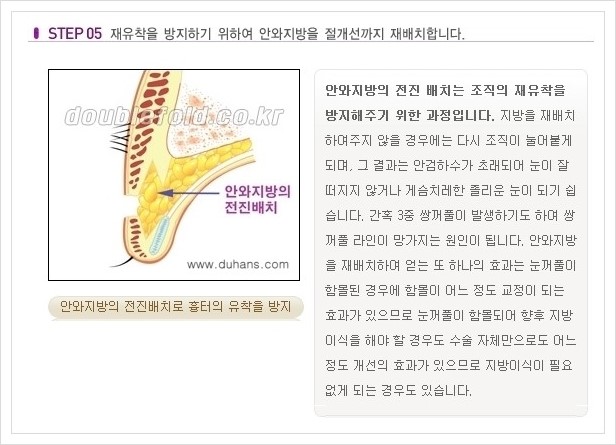 [두한성형외과 경쟁력 쌍꺼풀 재수술, 극한 재수술] - [쌍꺼풀 재수술의 과정 안내 1.] 관련 이미지 5