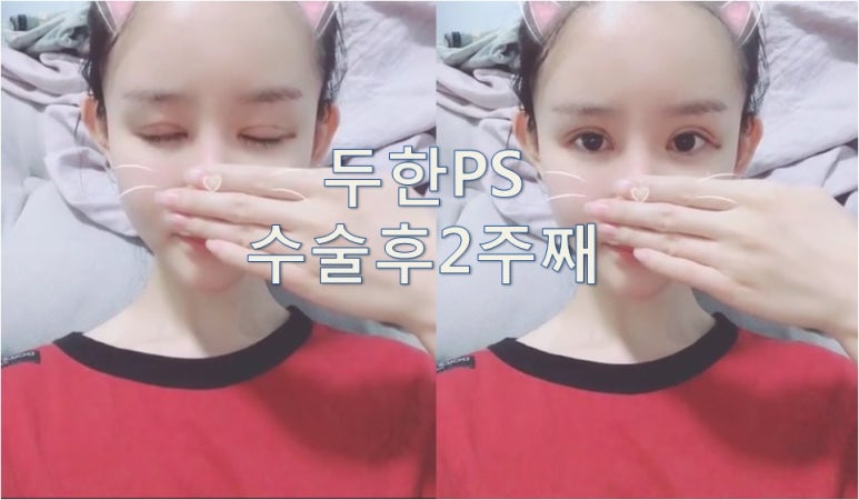 [두한성형외과 쌍꺼풀재수술]-[#라인키우기 #비대칭 #낮은라인 #울퉁불퉁 #짝눈] 관련 이미지 5