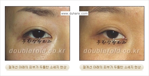 [두한성형외과 경쟁력 극한눈(쌍꺼풀)재수술] - [절개선 아래가 두툼한 소세지 쌍꺼풀 교정] 관련 이미지 3