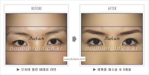 [두한성형외과 경쟁력 눈성형] - [나에게 맞는 어울리는 쌍꺼풀 라인] 관련 이미지 45