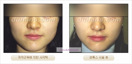 [두한성형외과 경쟁력 안면윤곽성형] - [보톡스(보툴리눔톡신)에 의한 사각턱 교정] 관련 이미지 9