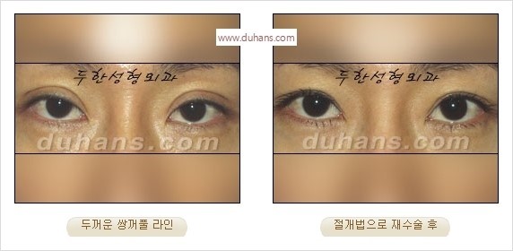 [두한성형외과 경쟁력 눈성형] - [나에게 맞는 어울리는 쌍꺼풀 라인] 관련 이미지 9