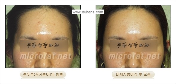 [두한성형외과 경쟁력 미세지방이식] - [관자놀이(측두부) 지방이식] 관련 이미지 9