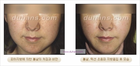[두한성형외과 경쟁력 지방흡입] - [볼살, 턱선의 간편 지방흡입] 관련 이미지 22